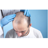 implante de cabelo para homem Setor de Mansões Dom Bosco