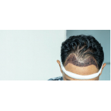 implante de cabelo para mulheres tratamento Confresa