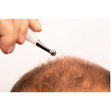 mesoterapia para cabelo procedimento Cuiabá