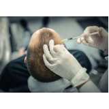 onde fazer cirurgia de implante de cabelos Porto Esperidião