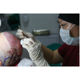 onde fazer procedimento implante capilar Tapurah