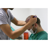 onde fazer procedimento para implante de cabelos Cuiabá