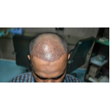 procedimento de implantação de cabelo Cuiabá