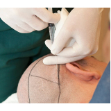 procedimento de implante capilar alopecia androgenética Santa Helena de Goiás