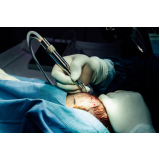 procedimento de implante capilar para diminuir coroa Porto Esperidião