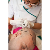 procedimento de implante capilar para reduzir coroa Campo Novo do Parecis