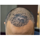 procedimento de implante de cabelo na coroa Park Way
