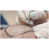 procedimento de implante de cabelo nas entradas Marcelândia