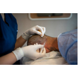 procedimento de mesoterapia cabelo Chapada dos Guimarães