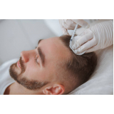 procedimento de mesoterapia capilar masculina Naviraí
