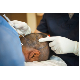 procedimento de mesoterapia capilar para homens Colíder