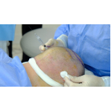 procedimento de transplante capilar na coroa Nova Ubiratã
