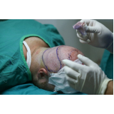 procedimento para implante de cabelos Asa Norte