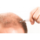 tratamento de mesoterapia para cabelo Peixoto de Azevedo