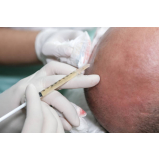 tratamento de mesoterapia para cabelos Colniza